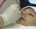 лечение полипов полипы